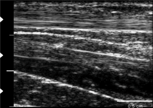 clinical image human forearm tendons